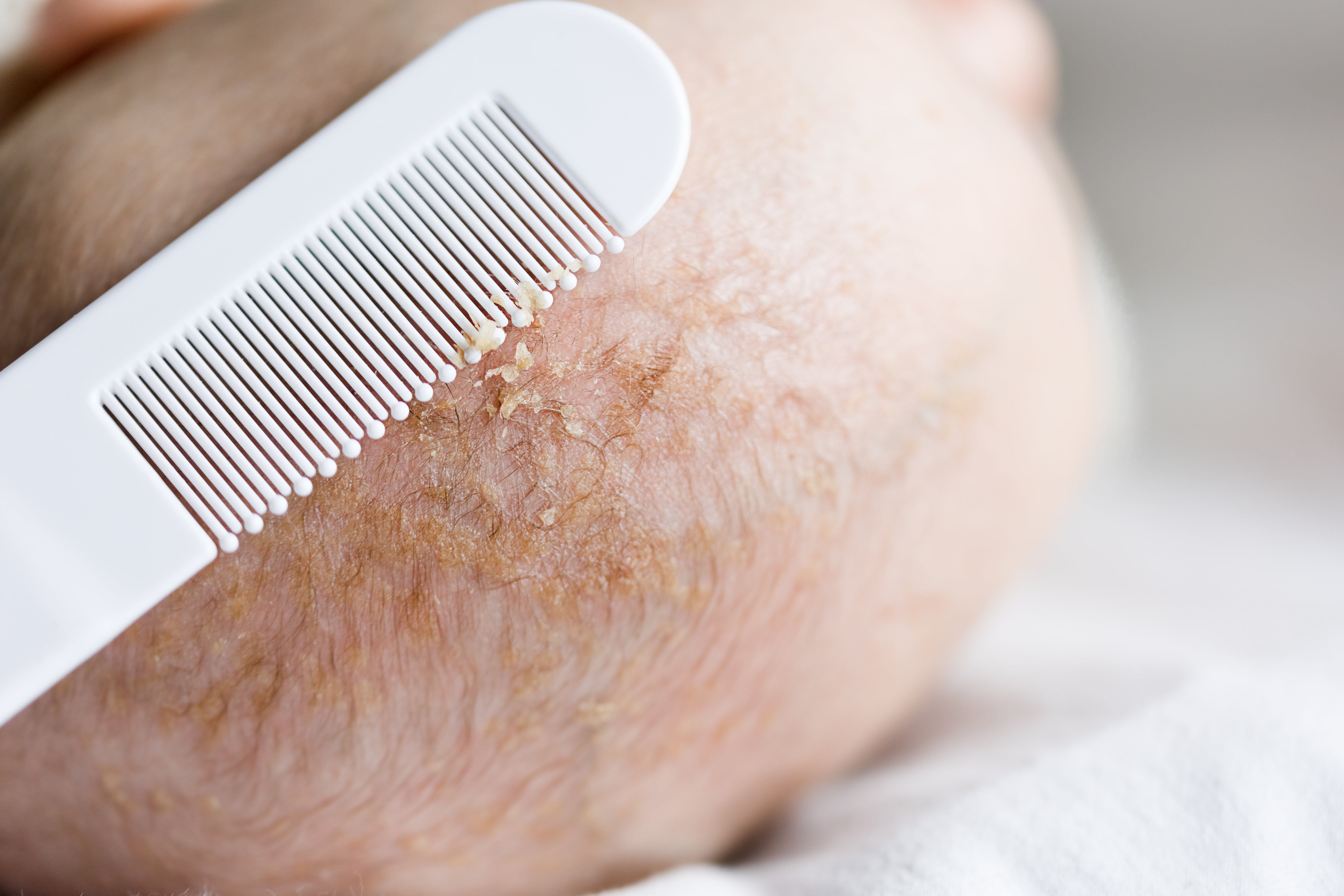 What is Cradle Cap and How To Treat It? – Bailey Alice